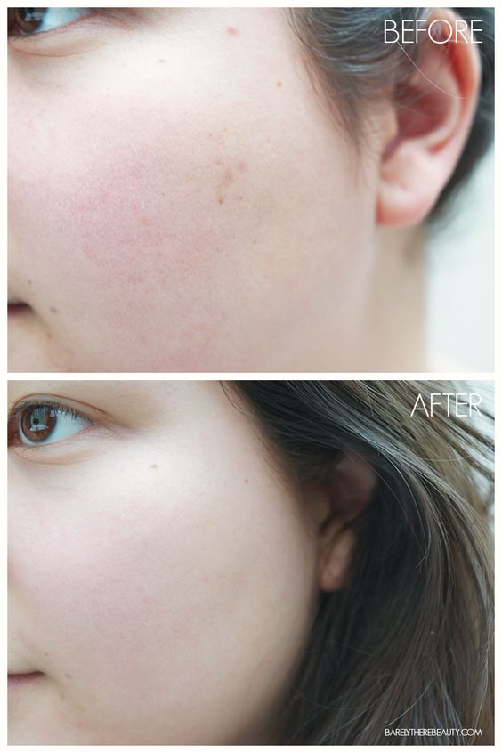 korean-skincare-cosrx-aha-bha-clarifying-treatment-toner-before-after-acne
