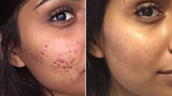 image 51 How to Get Rid of Your Cystic Acne Permanently