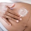 best cream to prevent stretch marks during pregnancy