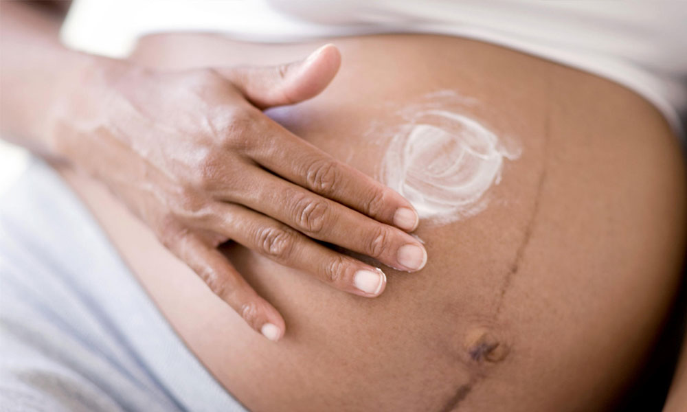 best cream to prevent stretch marks during pregnancy