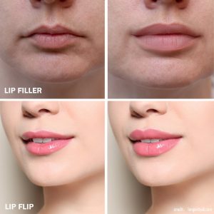 Lip-Flip and Lip-Fillers