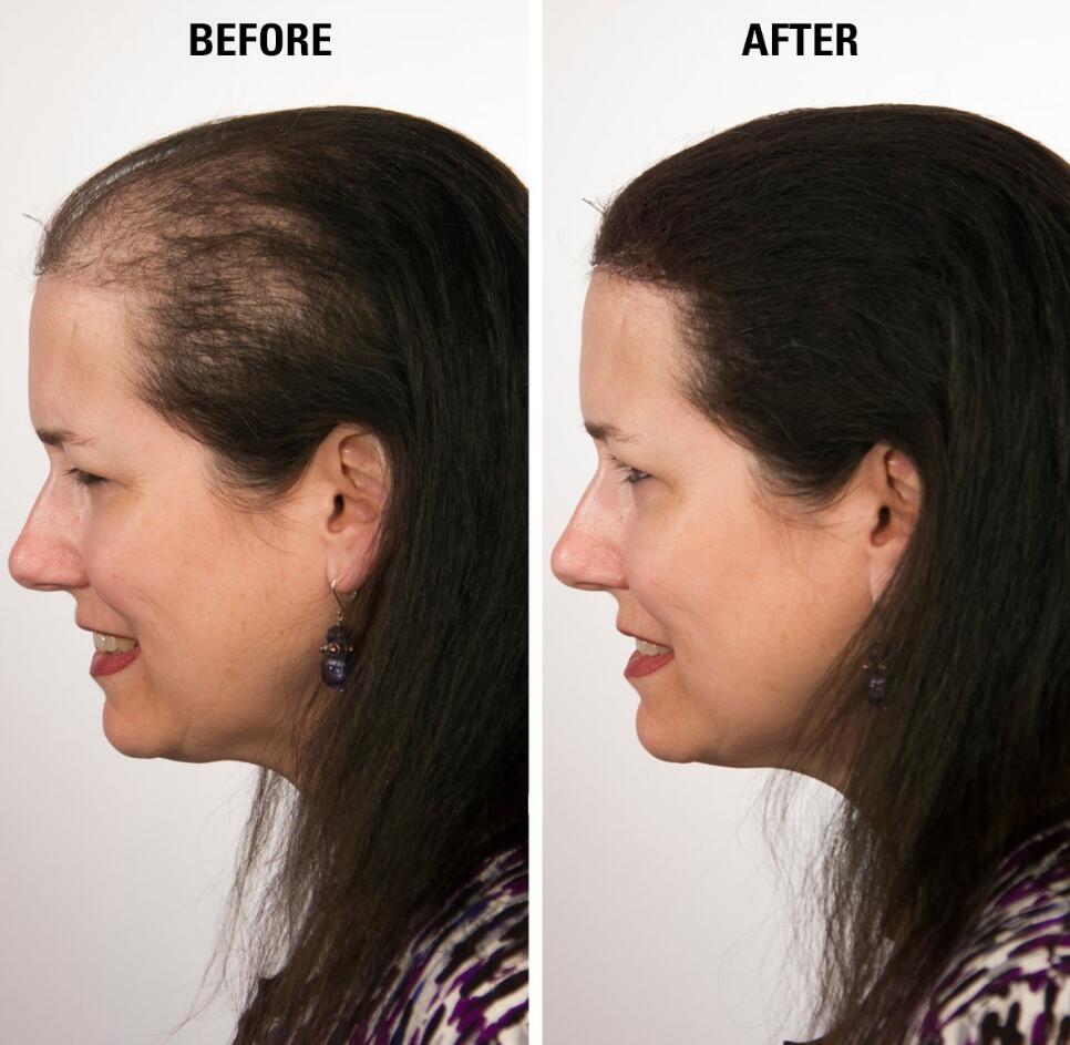Hair Fibers for Thinning Hair before and after