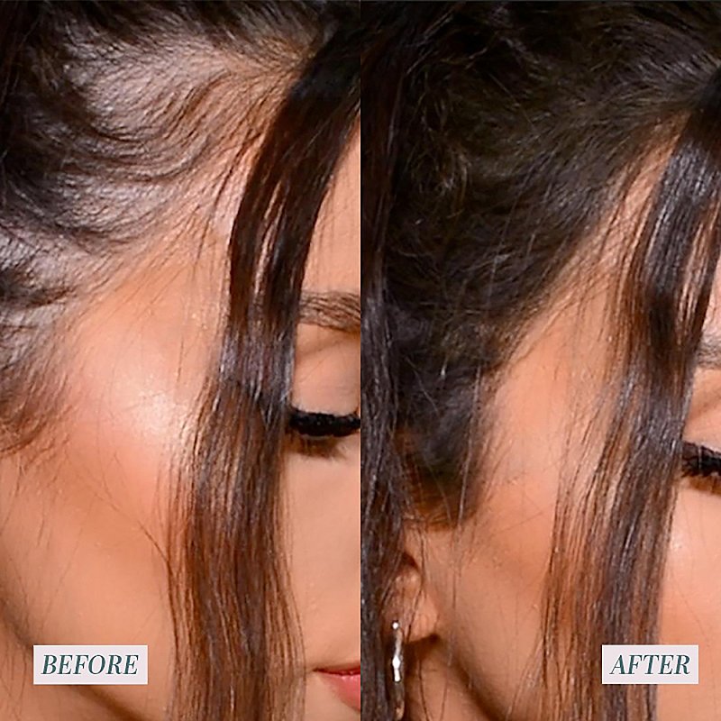 hair fillers before and after
