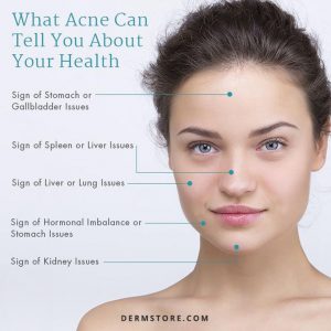 Face mapping What Your Acne Is Telling You