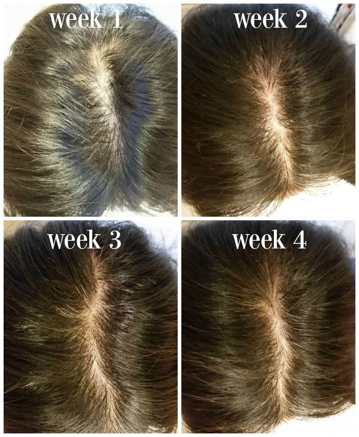 Nioxin System 3 before and after