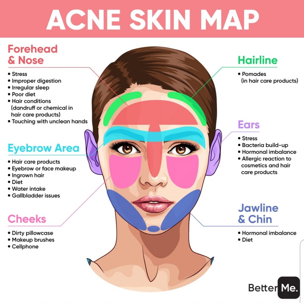 acne skin map - Face mapping